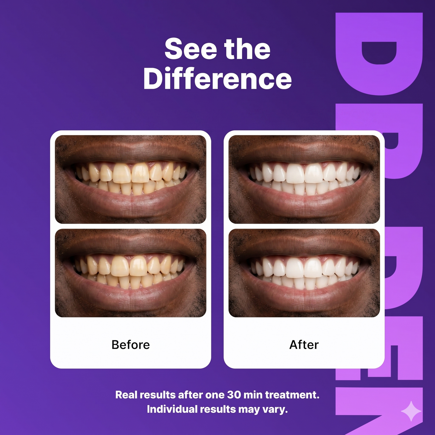 Purple Teeth Whitening Strips